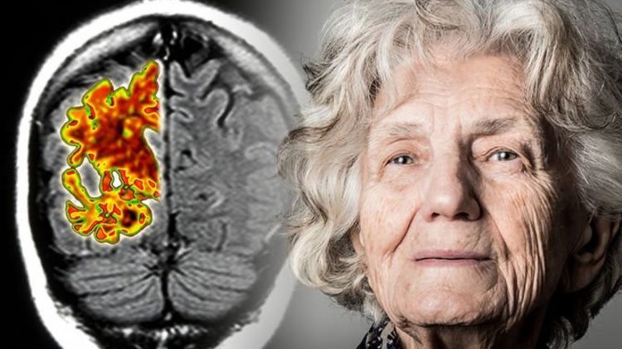 Tyto neurony v mozku těží z fyzické aktivity a pomáhají zpomalit rozvoj Alzheimerovy choroby